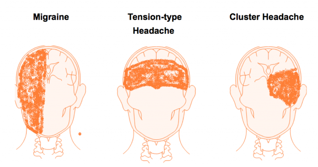 De gauche à droite: migraine, maux de tête de type tension, maux de tête en grappe